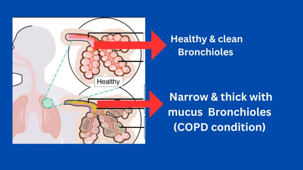 COPD icd 10 code and copd affected body part
