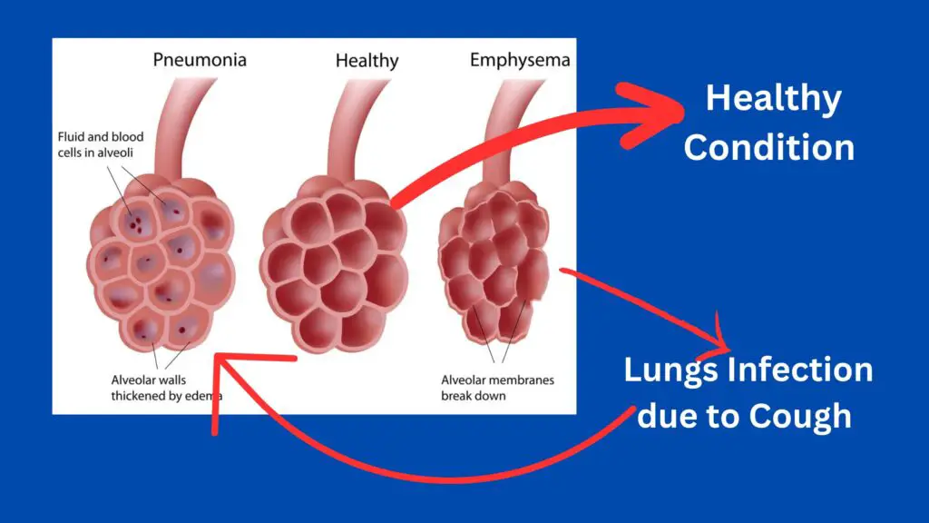 ICD 10 codes for cough