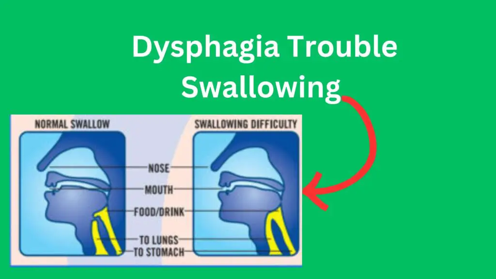 Dysphagia ICD 10 codes list