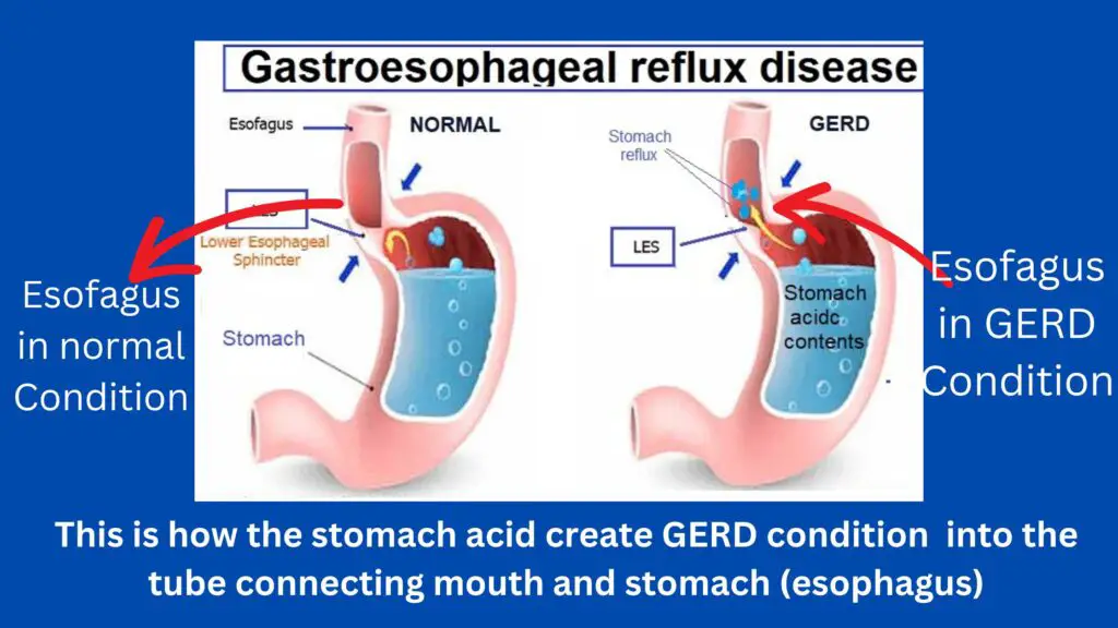 GERD into the tube connecting your mouth and stomach (esophagus).