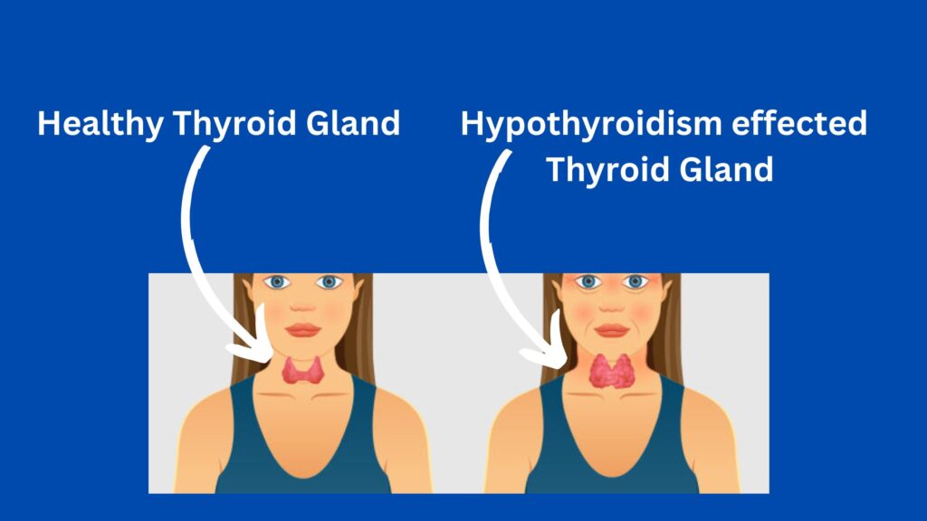 Hypothyroidism icd 10 code, symptoms and treatment